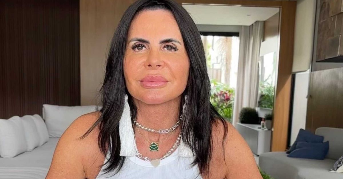 O que aconteceu com Gretchen? A cantora surge irreconhecível e explica hematomas olhos inchados